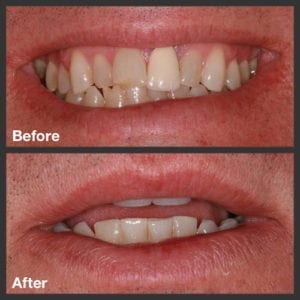 Teeth Bonding For Gaps Procedure